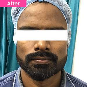 Chemical Peel Treatment After Image
